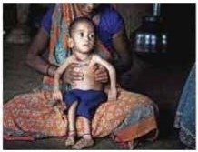 অপুষ্টিজনিত রোগ