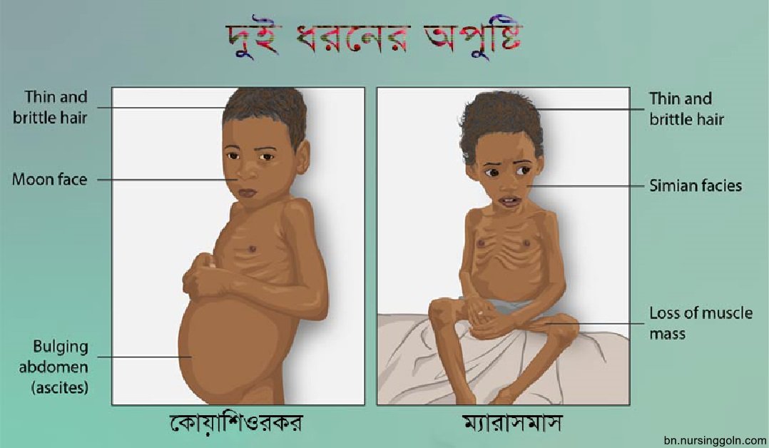 অপুষ্টির কারণ