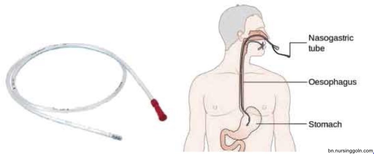 এন জি নল বা নাকের নল