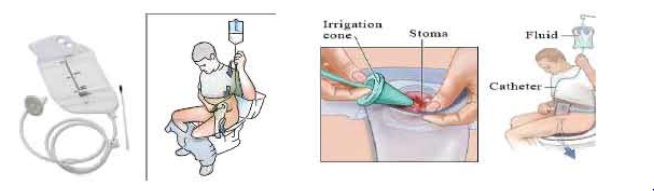 কোলস্টোমি ব্যাগ