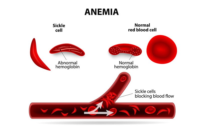 অ্যানিমিয়া বা রক্তশূন্যতা